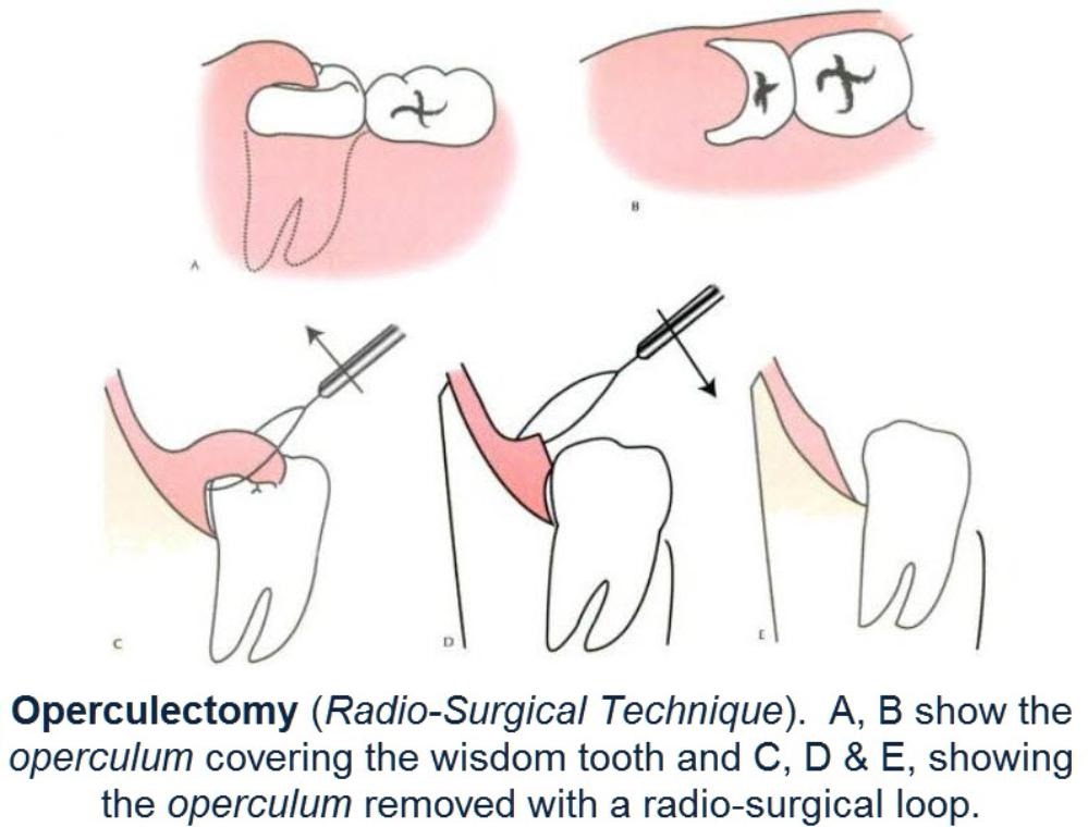Operculectomy